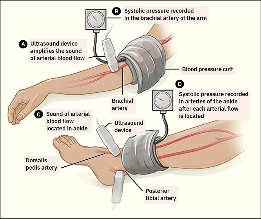 A diagram explaining the ankle-brachial index (ABI) test).