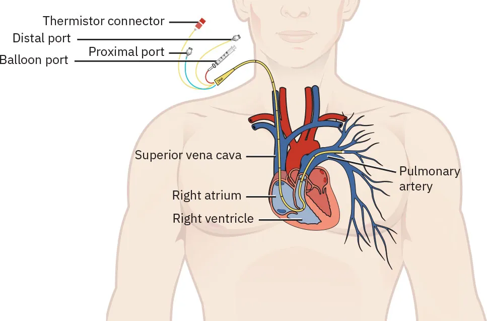 A color illustration showing an attached pulmonary artery catheter. The heart is shown and labeled with pulmonary artery, right atrium, right ventricle, and superior vena cava. The catheter passes through the superior vena cava, right atrium, right ventricle, and out the pulmonary artery. On the other end of the catheter is a balloon port, proximal port, distal port, and thermistor connector.