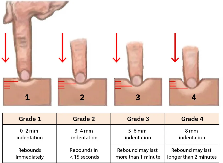 A diagram showing the different grades of edema.