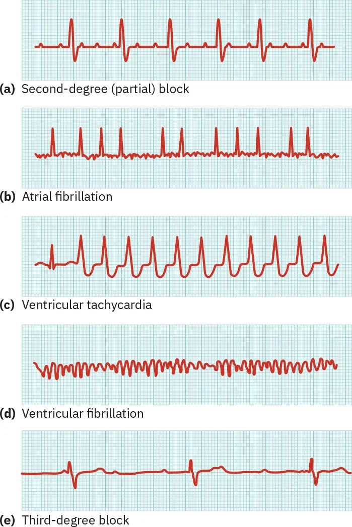 A diagram showing five different types of common abnormal ECG results.