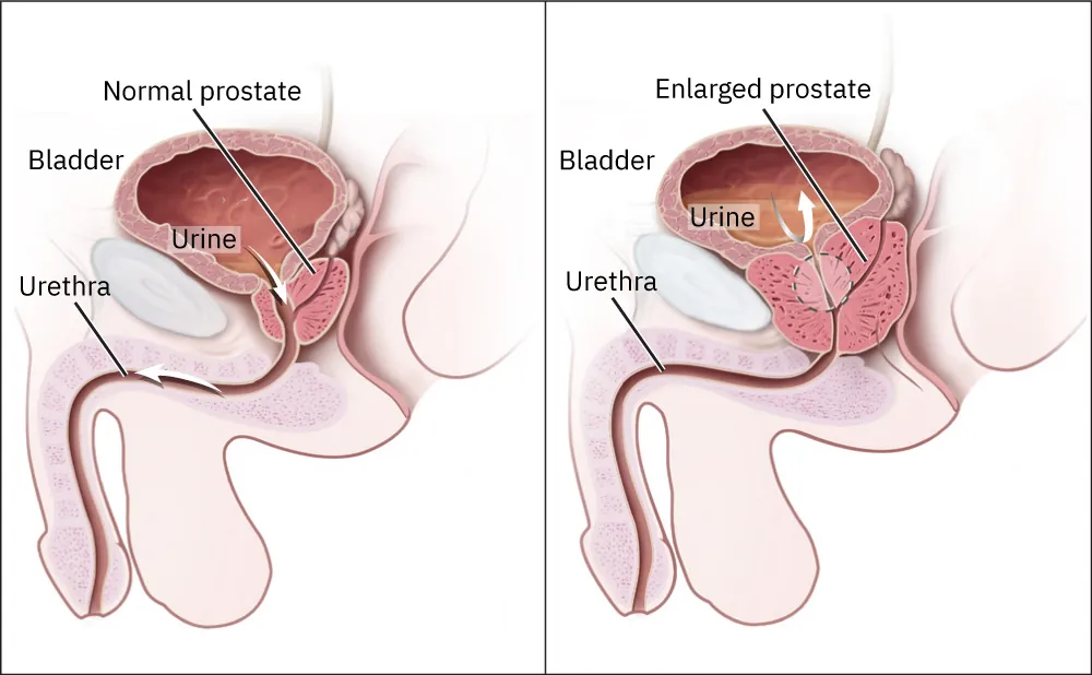 An anatomical illustration comparing a normal prostate with an enlarged prostate. The left side shows a normal prostate with the bladder, urethra, and the flow of urine labeled. The right side shows an enlarged prostate, highlighting how it compresses the urethra and affects urine flow from the bladder.