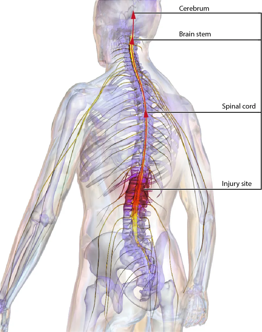 A diagram of a human torso showing the bone structure. The spine is labeled with the following: “injury site,” “Spinal cord,” brain stem,” and “cerebrum.”
