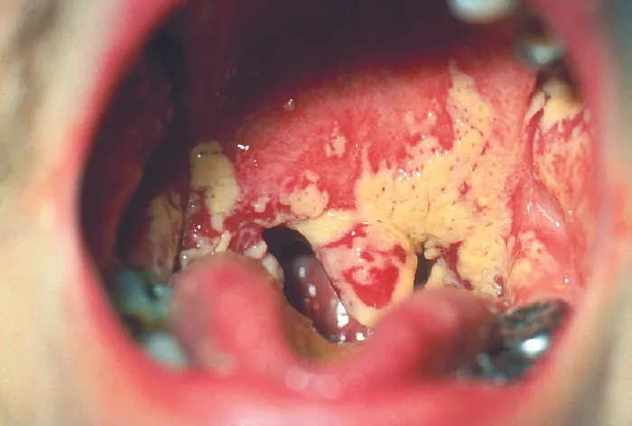 White lumpy patches in the mouth.