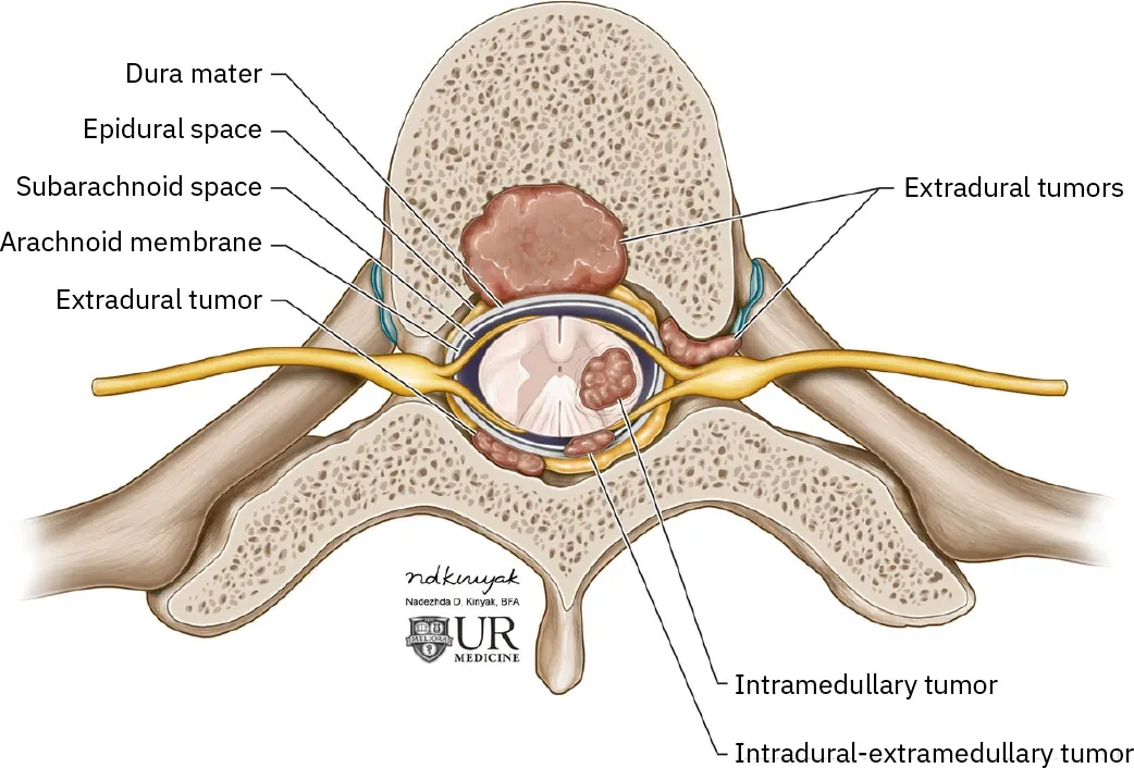 Illustration of spine sliced open, with labels for: Dura mater, Epidural space, Subarachnoid space, Arachnoid membrane, Extradural tumor, Extradural tumors, Intramedullary tumor, Intradural-extramedullary tumor.