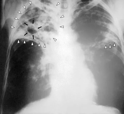 Chest X-ray. Description below.