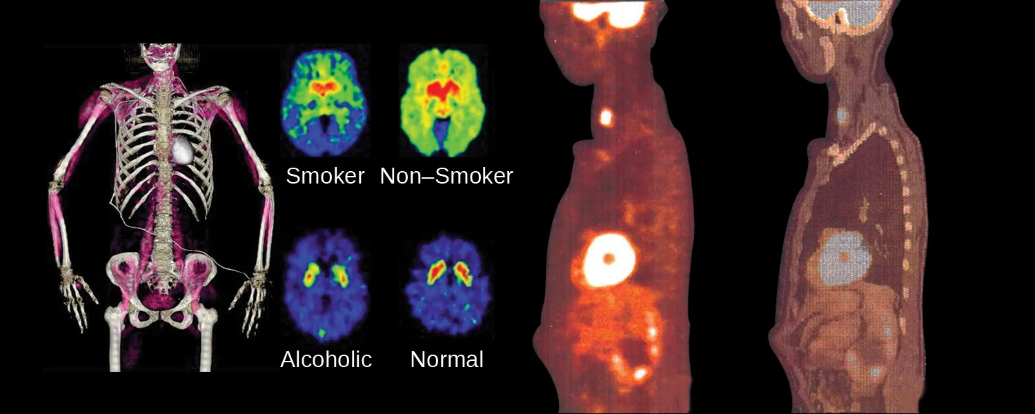 An image shows four sets of medical pictures. The first is the torso and arms of a human skeleton with purple shading in the muscular regions. The second is a set of four images; the top left, labeled “Smoker,” shows an oval-shaped image that is blue on the outside rim, green as you move inward, and bright red near the center while the top right, labeled “Non-Smoker,” shows an oval-shaped image that is shaded bright green over most of the image and bright red near the center. The lower left image of the four, labeled “Alcoholic,” shows an oval-shaped image that is almost entirely blue with two small yellow-rimmed, red dots near the upper middle section while the lower right image, labeled “Normal,” looks very similar to the lower left, but the red regions are slightly larger. The final image show two scans of a human torso that is turned to face to the side. The left scan has three bright yellow-white areas; one in the throat, one in the chest and one in the head. The right scan is the same as the left except the bright regions are dim and the internal organs are more clearly defined.