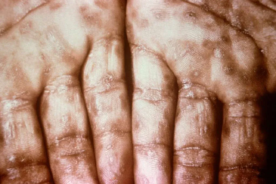 A photograph of the palms of two hands showing rashes along the palms and fingers.