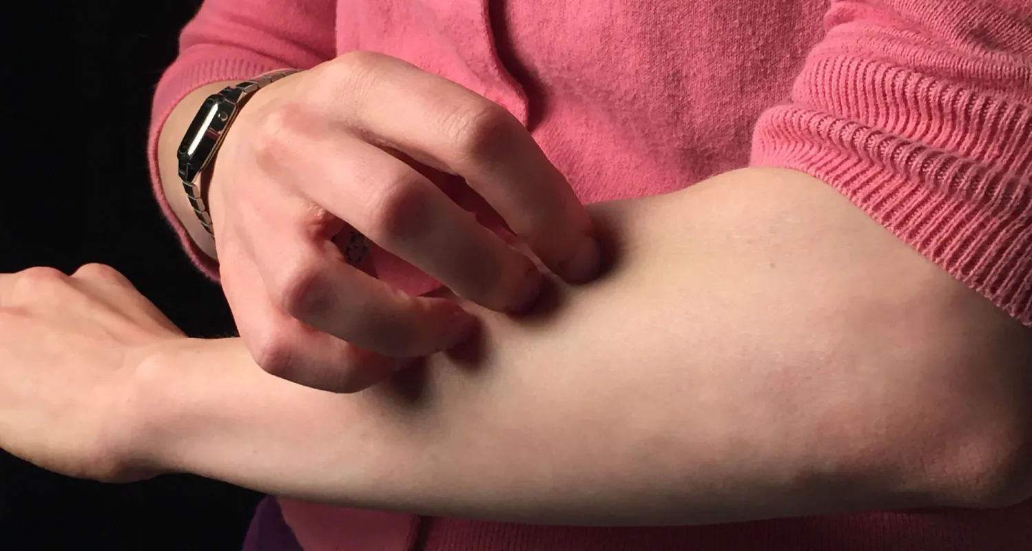Photo of individual scratching their arm with their fingers.