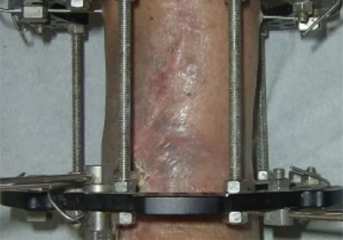 External fixation using brace around limb