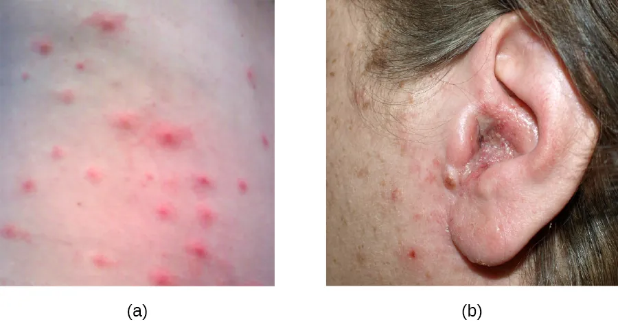Acne and swollen ear.