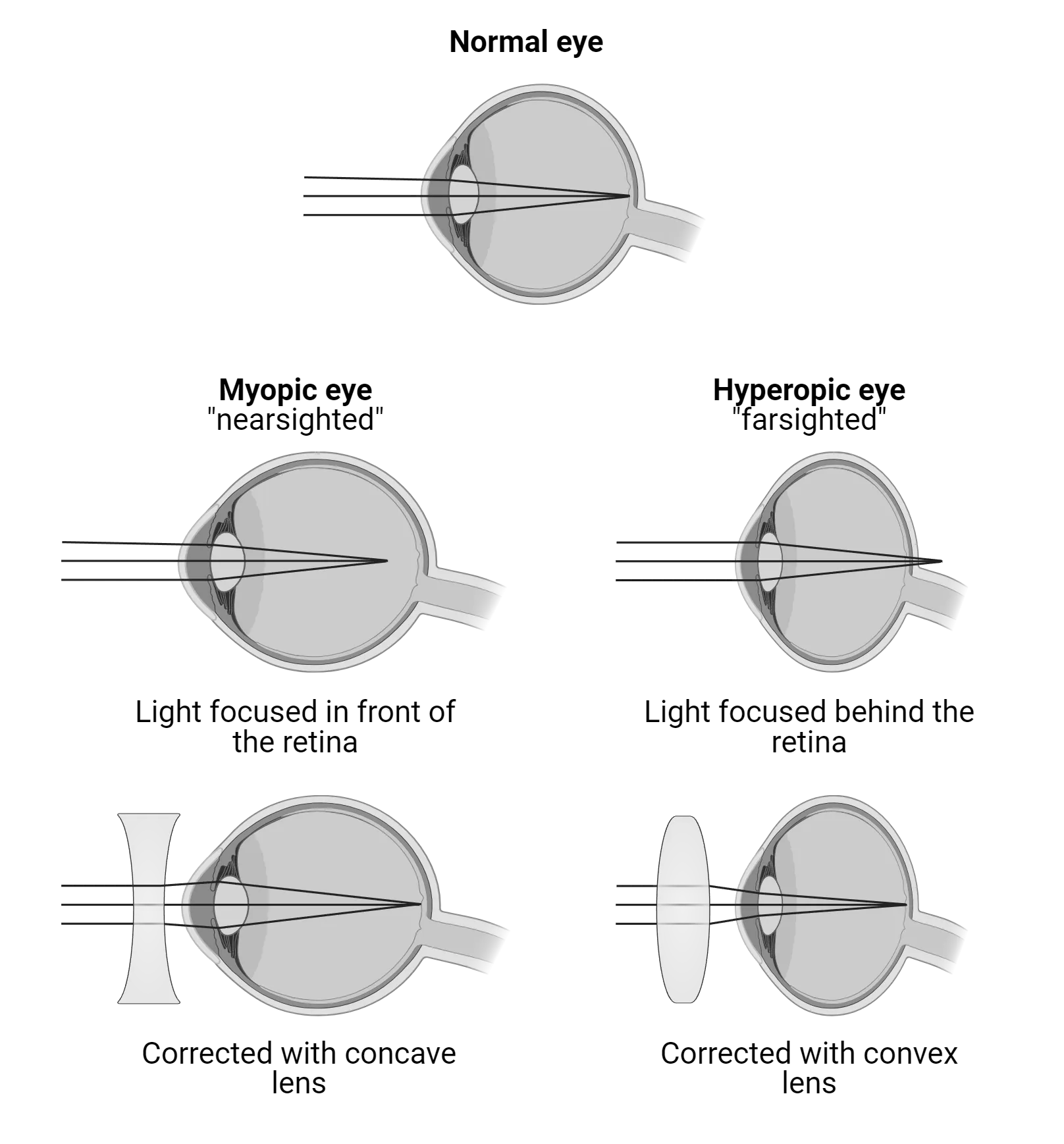 A series of images of sagittal slices of eyes. A normal eye has round shape and rays of parallel light entering the lens are focused on a single point on the retina in the back of the eye. A myopic eye appears elongated and the rays of light reach a point in front of the retina. Corrective lenses expand the rays of light and the focus point returns to the retina surface. A hyperopic eye appears shorter and the rays of light reach a point behind the retina. Corrective lenses narrow the rays of light and return the focus point on the retina surface.