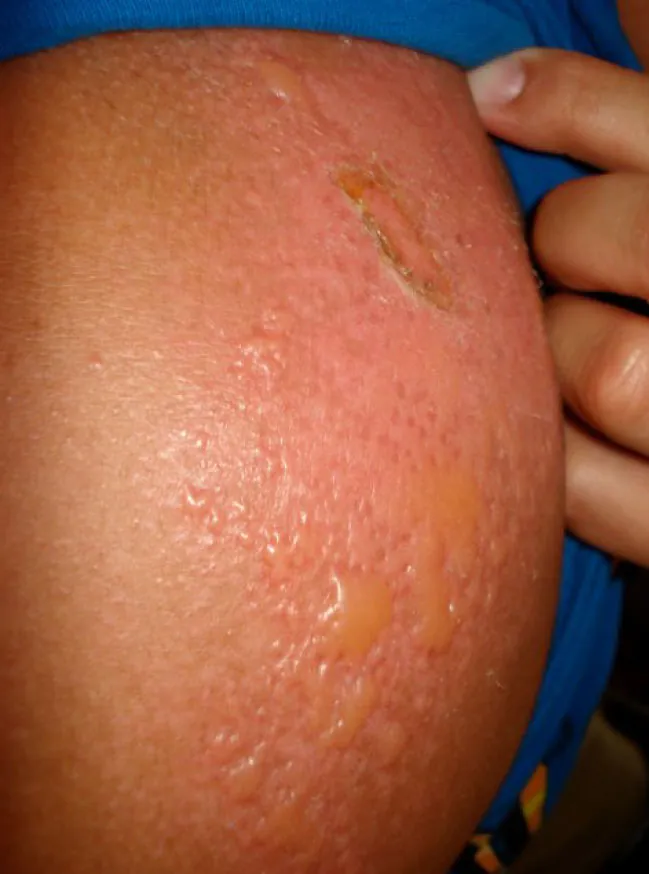 Photo of second degree burn on a shoulder with liquid filled blisters.