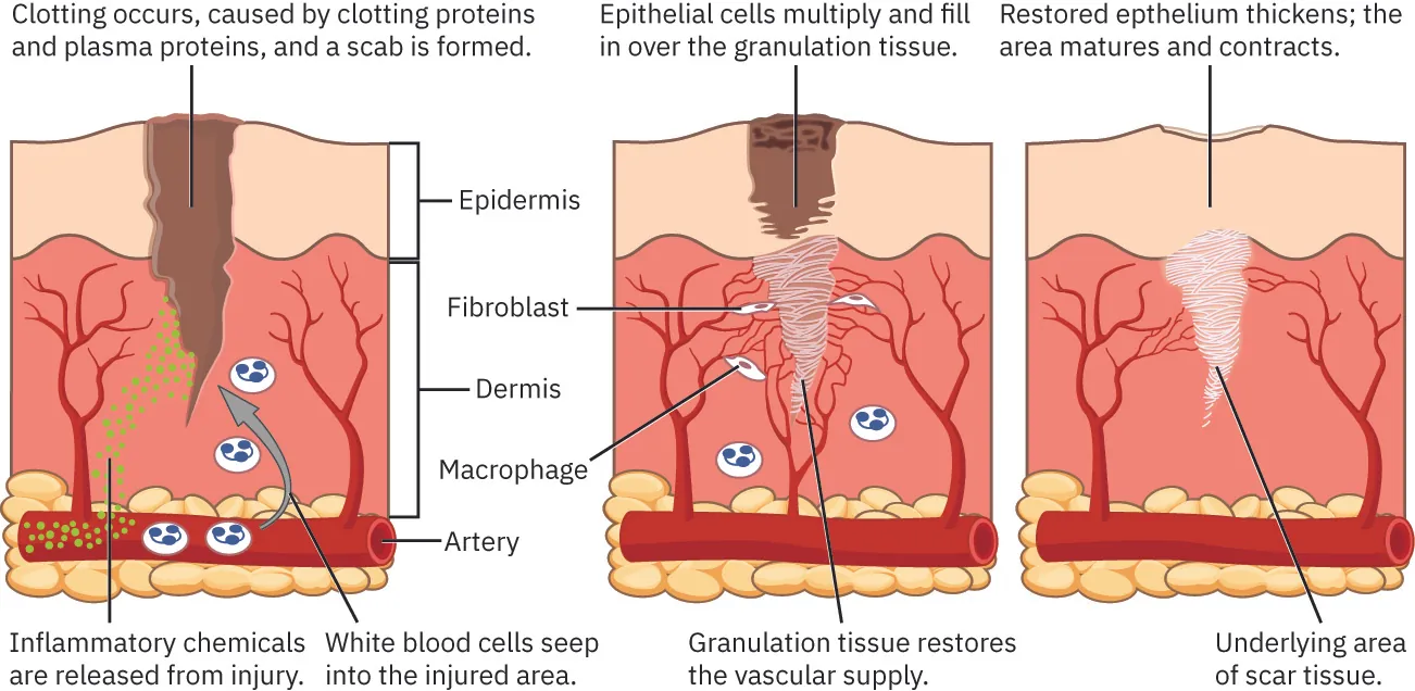 The three major phases a wound goes through while healing