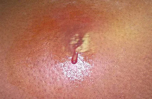 The image displays an inflamed area of skin with a small lesion or sore that is secreting pus or blood as seen in MRSA.