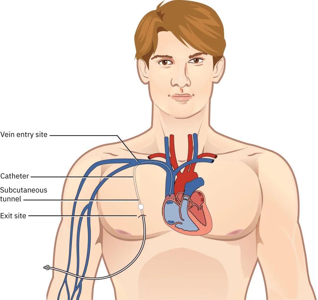 A tunneled HD catheter.