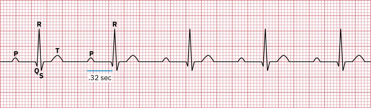 Sinus rhythm showing PR interval greater than 0.20 seconds.