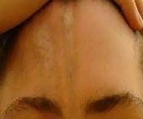 A photo of forehead skin with scleroderma.