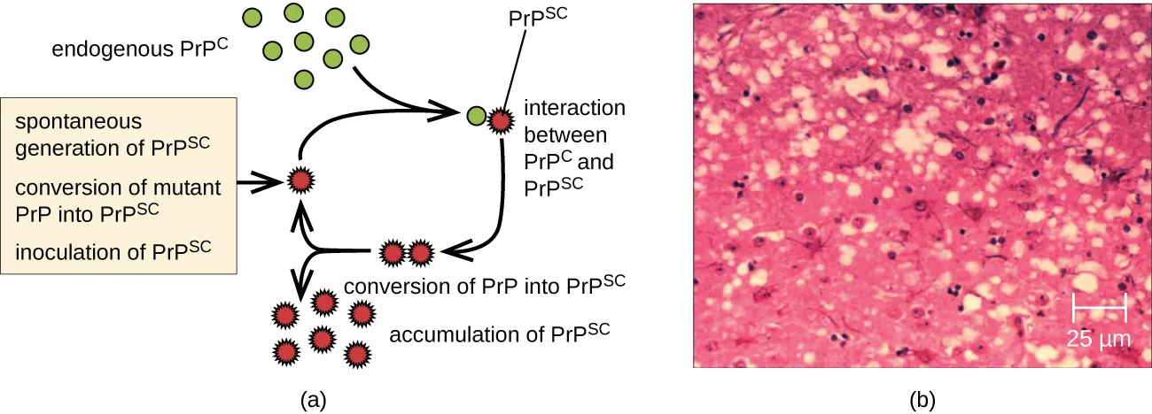 Effects of rogue prions on brain tissue. Description below.