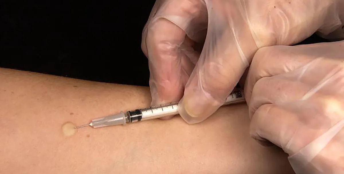 A photograph shows a healthcare provider administering needle injection into patient’s arm with visible wheal.