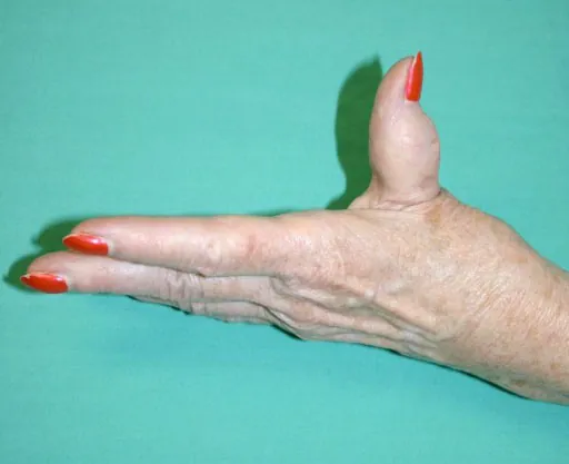 Hand with swelling in thumb