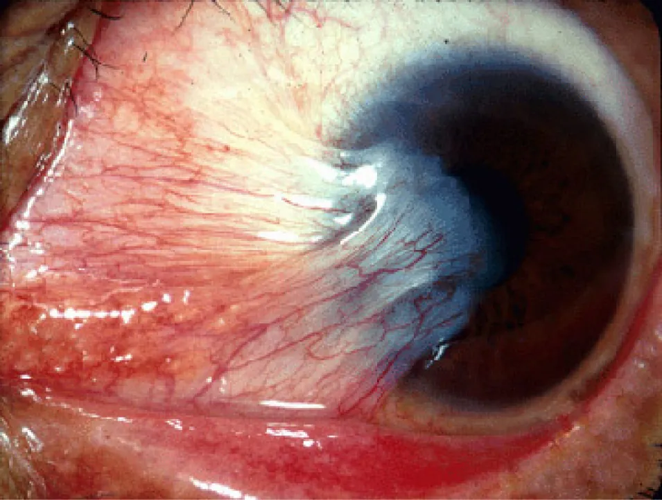 Pterygium of the right eye