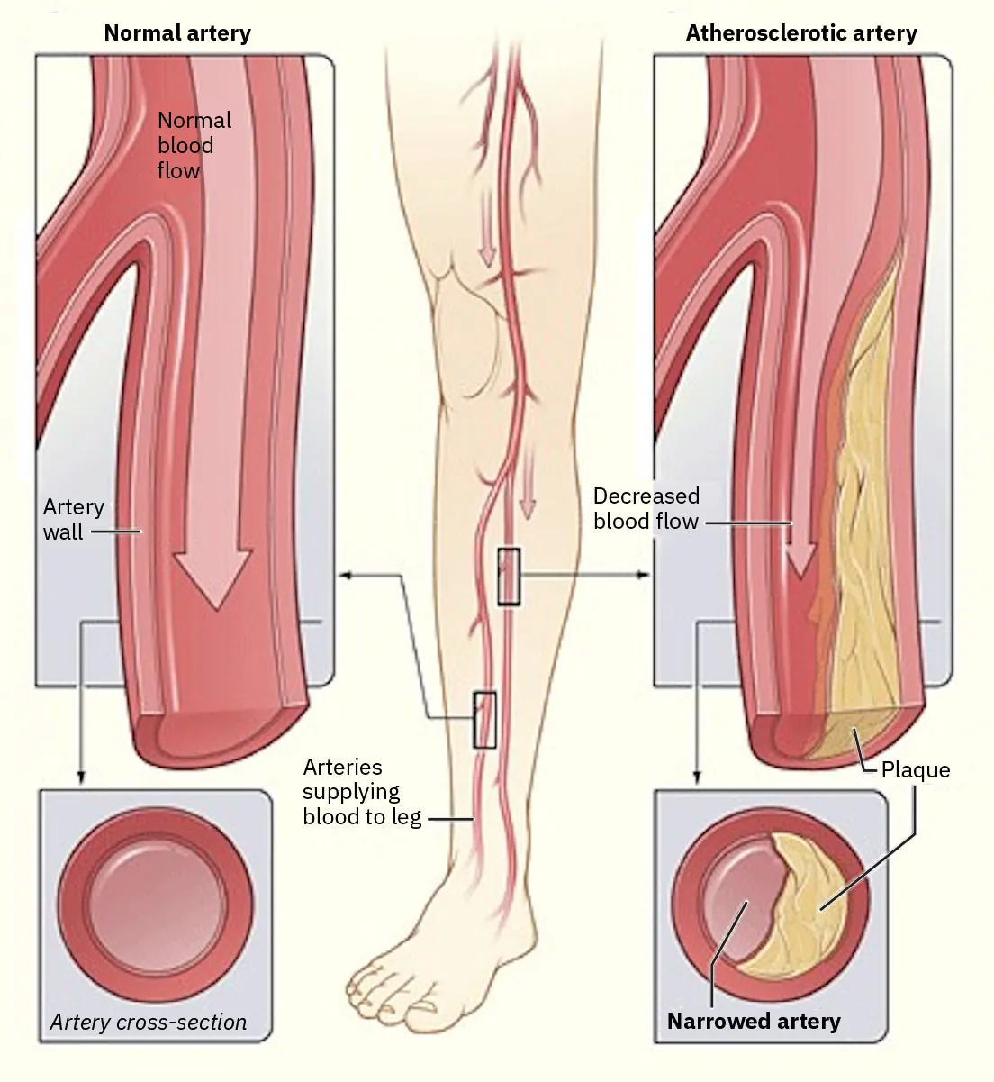 Diagram showing Normal artery and Atherosclerotic artery, labeling Arteries supplying blood to leg, Normal artery labeled with Normal blood flow and Artery wall and showing Artery cross-section, Atherosclerotic artery labeled with Decreased blood flow and plaque and showing Narrowed artery.