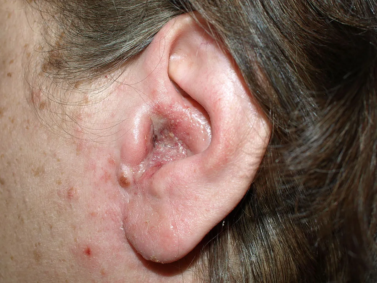 A photo of a person’s ear with swelling and infection caused by otitis externa.