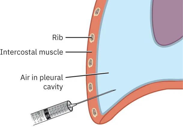 Diagram showing aspiration of pneumothorax, labeling rib, intercostal muscle, and air in pleural cavity.