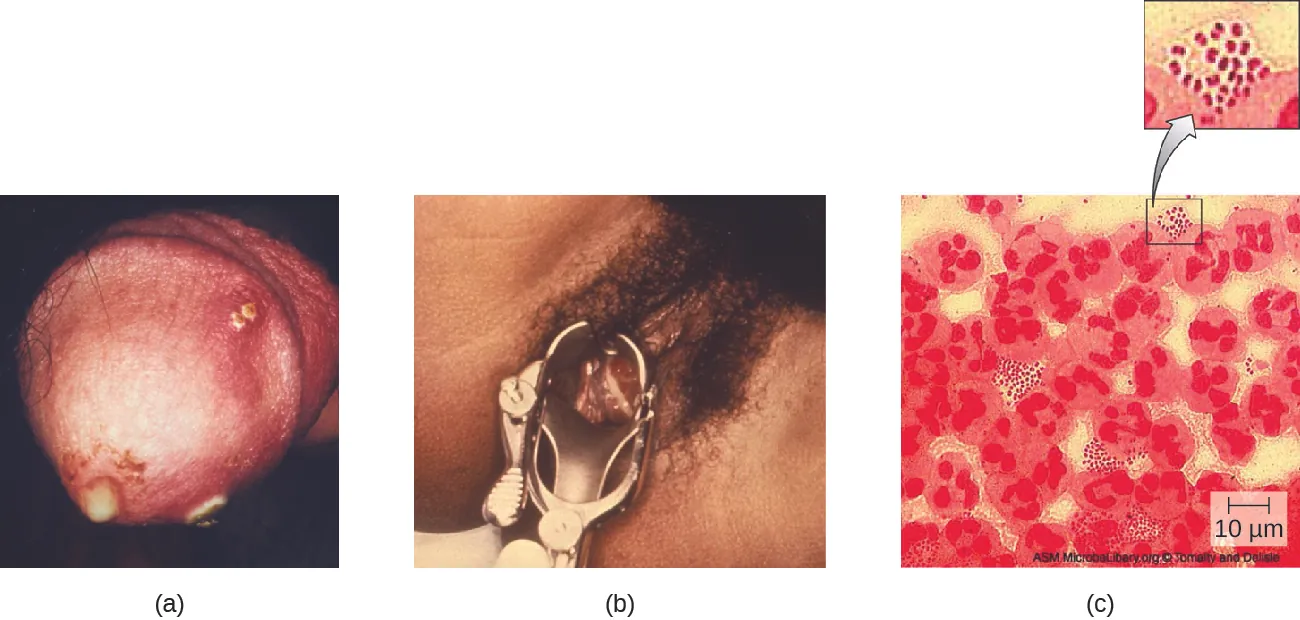 Gonorrhea. Description below.
