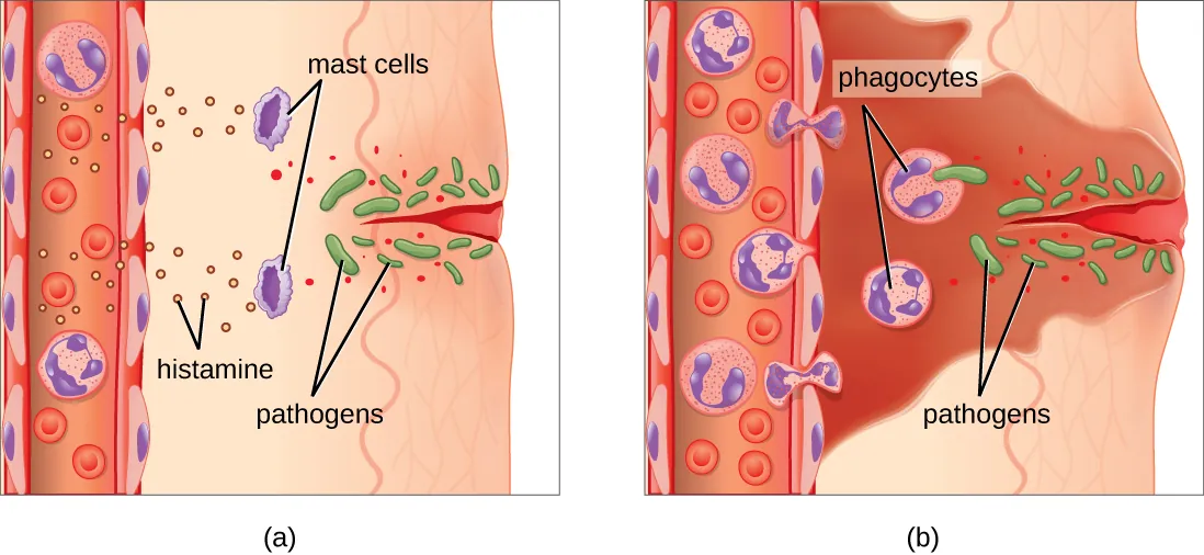 Acute inflammation. Description below.