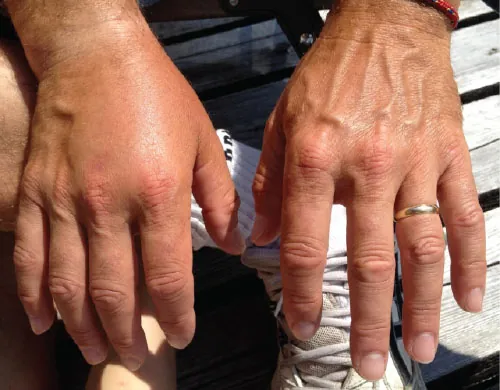 A photo of a normal hand next to a swollen hand due to peripheral edema.