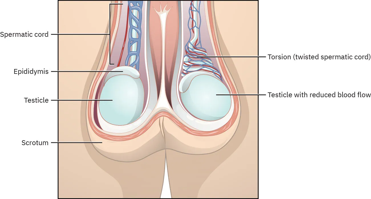 A color illustration showing testicular torsion. The illustration shows twisted spermatic cord connected to the testicle and causing reduced blood flow.