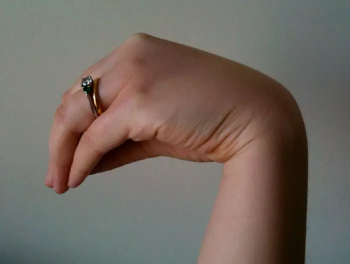 Image showing the involuntary wrist flexion after the application of a blood pressure cuff.