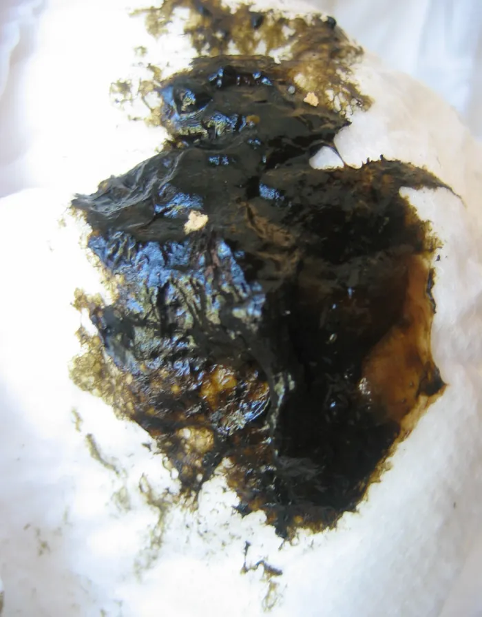 Photo of a diaper with meconium.