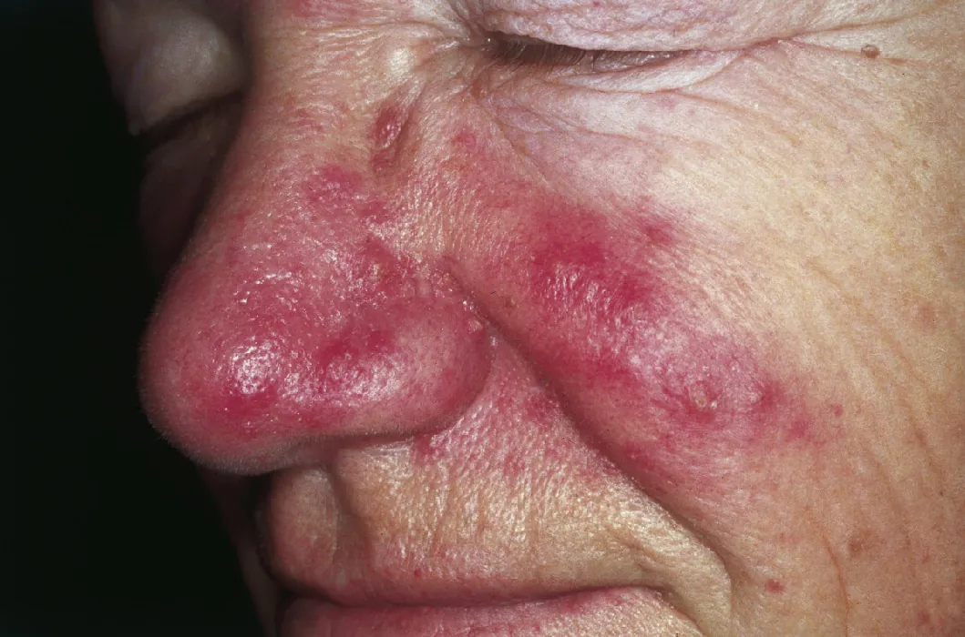 A closeup photo of a face with rosacea. The nose and cheek area is a deep red color, and there are some swollen red bumps as well.