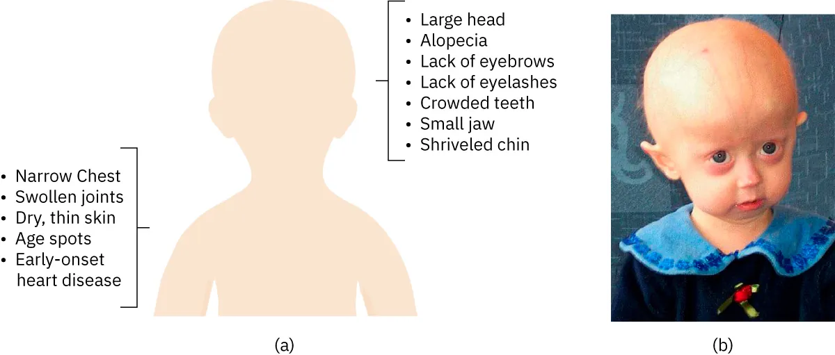 (a) Progeria physical symptoms: narrow chest, swollen joints, dry/thin skin, age spots, early-onset heart diseases, large head, alopecia, eyebrows/eyelashes lacking, crowded teeth, small jaw, shriveled chin. (b) Photo of child with progeria.
