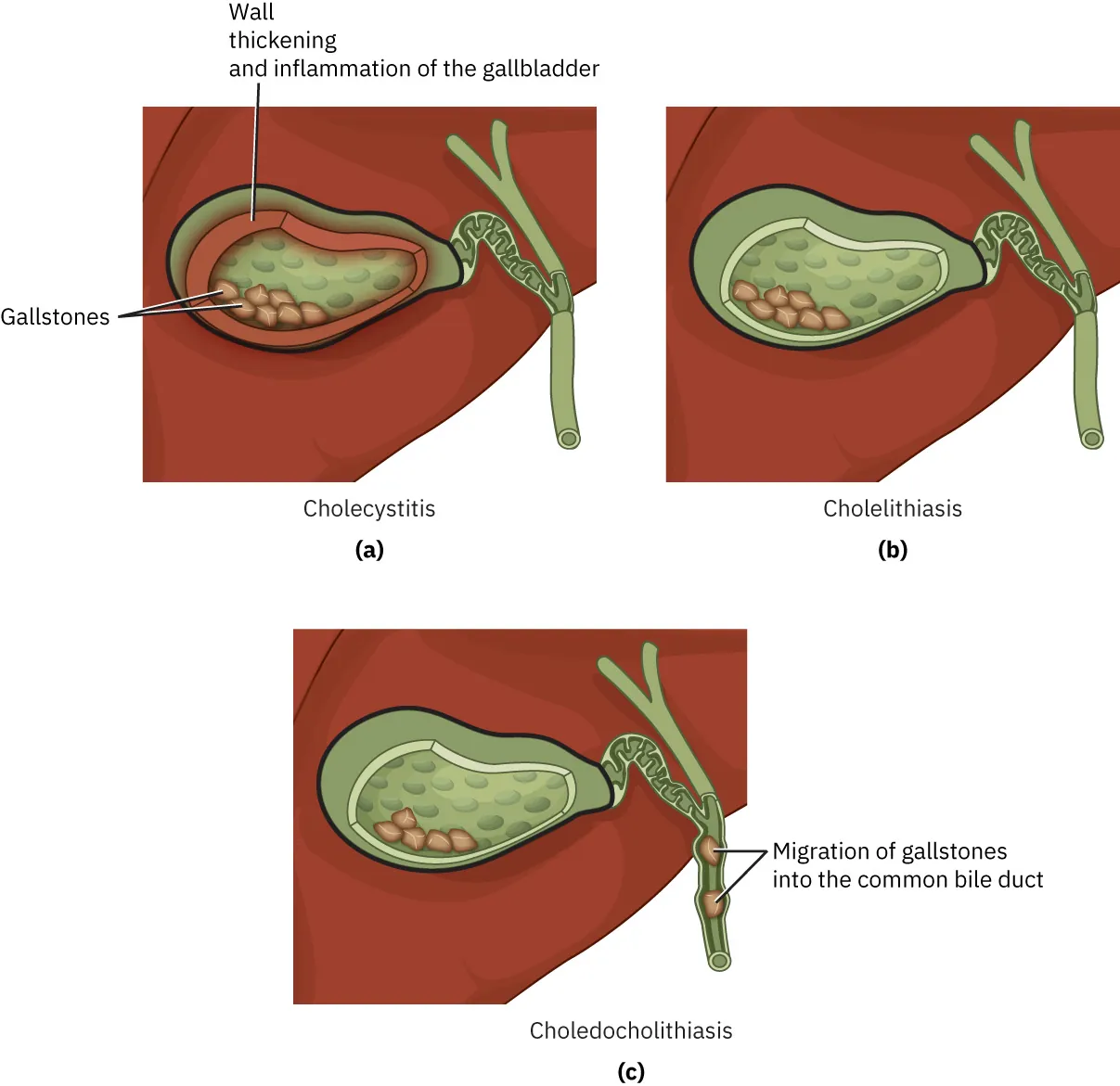 (a) Illustration showing Cholecystitis, labeling Gallstones, Wall thickening and inflammation of the gallbladder. (b) Illustration showing Cholelithiasis. (c) Illustration showing Choledocholithiasis, labeling Migration of gallstones into the common bile duct.