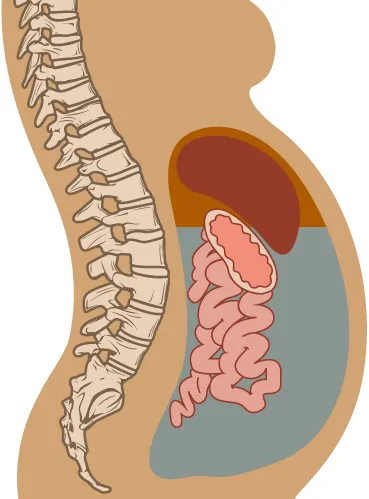 Illustration showing ascites in abdominal cavity.