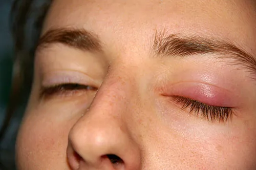 A photo of an eye with a swollen lump due to chalazion.