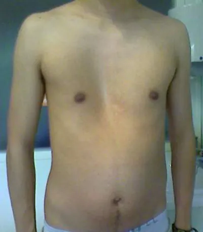 A photo of a patient with pectus excavatum.
