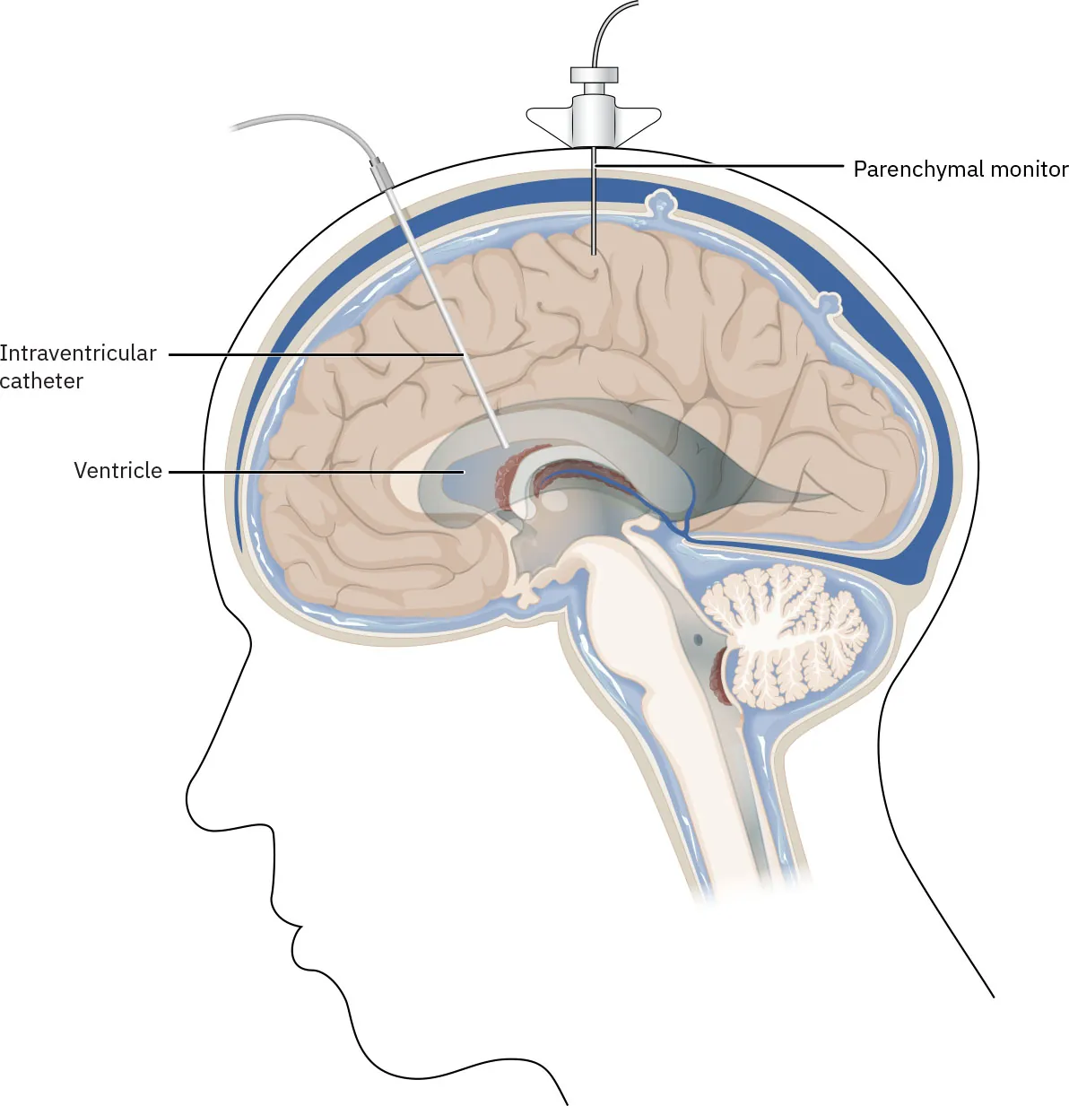 Diagram showing ventriculostomy, labeling Intracranial pressure monitor bolt, Catheter, and Ventricle.