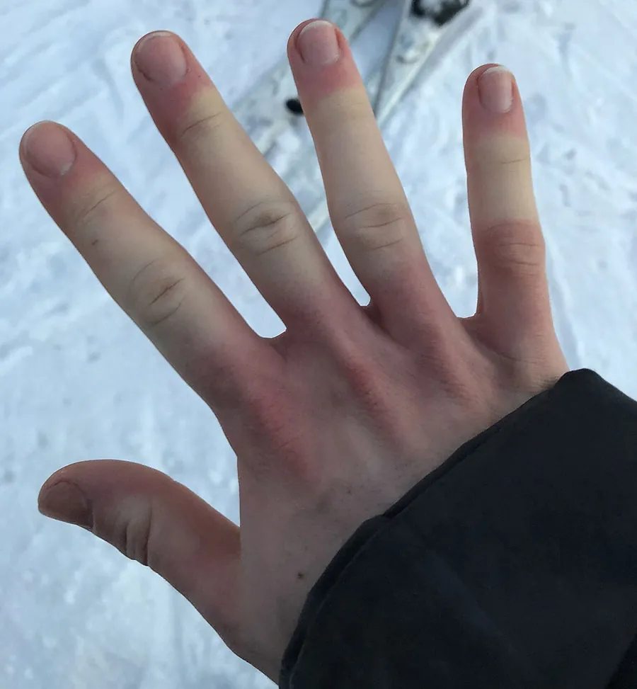 A photo of a person’s hand with a whiter color in the middle of the fingers.