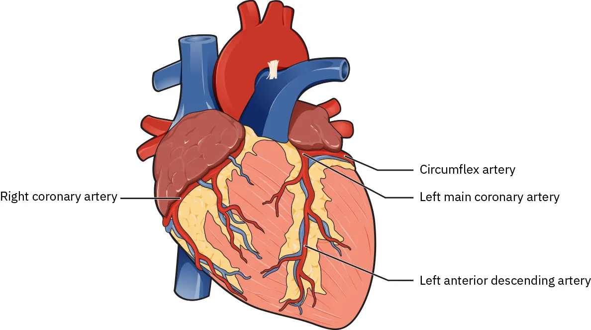 Diagram of heart labeling Right coronary artery, Circumflex artery, Left main coronary artery, Left anterior descending artery.