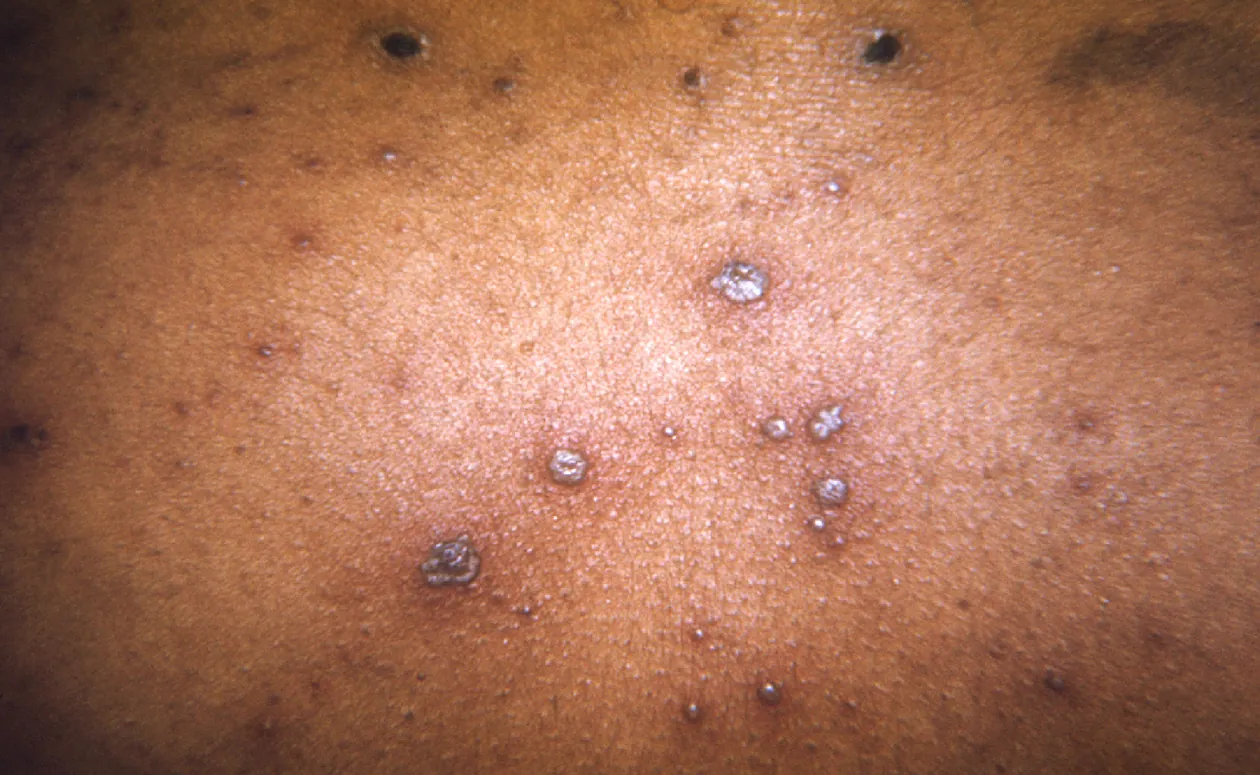 Chickenpox rash on the back of a person’s shoulders.