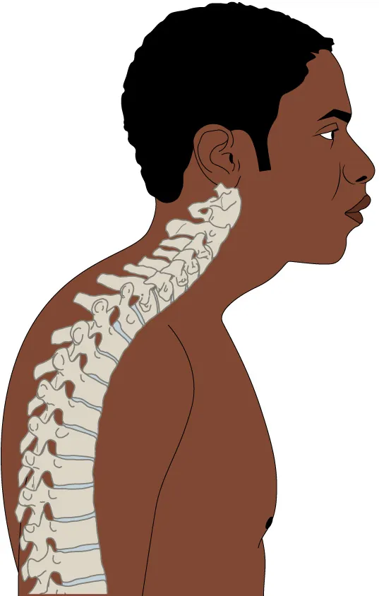 Diagram showing kyphosis