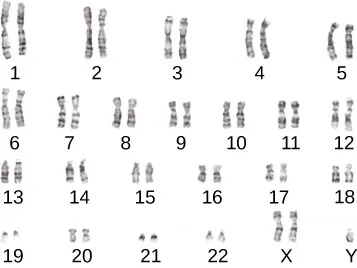 In this micrograph of a male human karyotype, an extra copy of the X chromosome is present, in addition to a Y chromosome. All other chromosomes show the normal diploid state with 2 copies