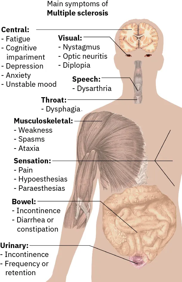 Multiple Sclerosis symptoms: Central (Fatigue, Cognitive impairment, Depression/Anxiety, Unstable mood) , Visual (Nystagmus, Optic neuritis, Diplopia), Speech (Dysarthria), Throat (Dysphagia), Musculoskeletal (Weakness, Spasms/Ataxia), Sensation (Pain, Hypoesthesias, Paraesthesias), Bowel (Incontinence/diarrhea/constipation), and Urinary (Incontinence/Frequency/retention).