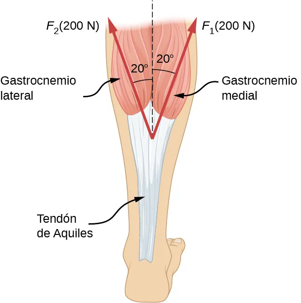 En la figura se muestra el tendón de Aquiles con dos fuerzas ejercidas sobre este por las cabezas lateral y medial del músculo gastrocnemio. F sub uno, igual a doscientos Newtons, se muestra como un vector que forma un ángulo de veinte grados hacia la derecha de la vertical, y F sub dos, igual a doscientos Newtons, se muestra en un ángulo de veinte grados hacia la izquierda de la vertical.