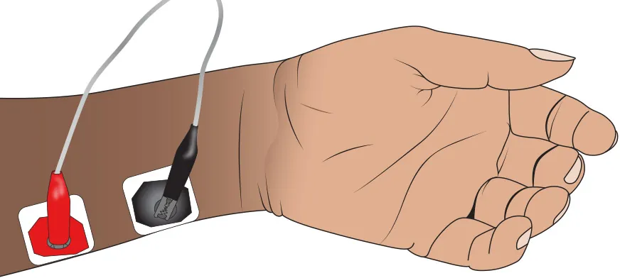 An image of a hand and part of the forearm, with a train-of-four monitoring device in the internal part of the forearm.