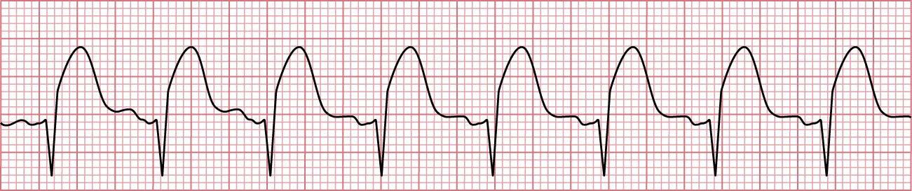 Sinus rhythm showing STEMI with EKG changes with elevation of ST segment in a 12 lead ECG.